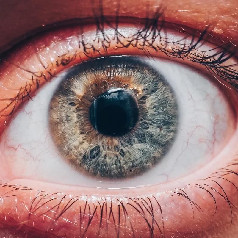 Plasmapheresis for Optic Neuritis: Treatment and Recovery