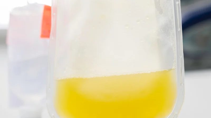 plasma exchange vs plasmapheresis