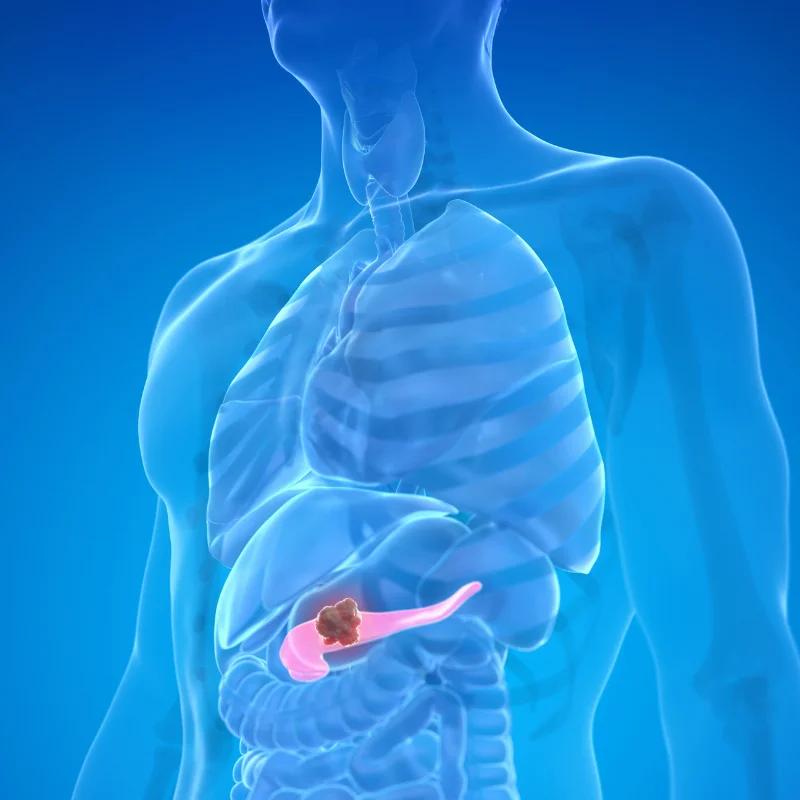 plasmapheresis for hyperlipidemic pancreatitis and alcohol