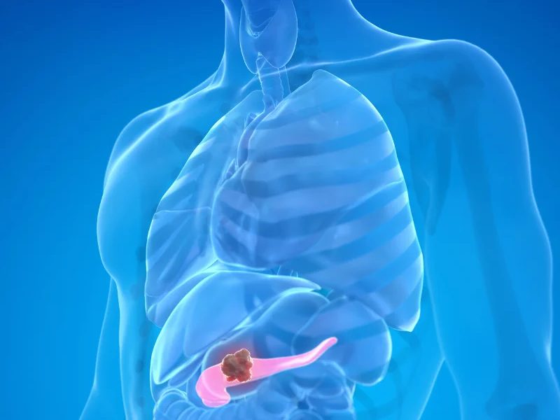 plasmapheresis for hyperlipidemic pancreatitis and alcohol