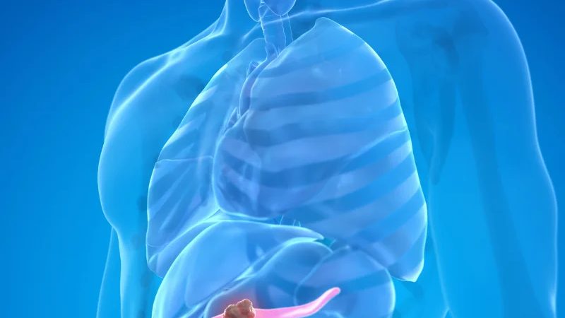 plasmapheresis for hyperlipidemic pancreatitis and alcohol