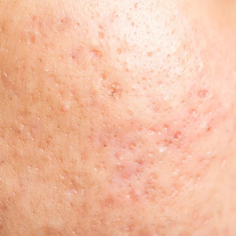 Does TRT Cause Acne? Causes, Risk Factors, and Treatment Options