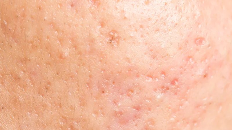 Does TRT Cause Acne? Causes, Risk Factors, and Treatment Options