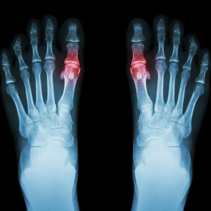 Plasmapheresis for Rheumatoid Arthritis: When Is It Used?