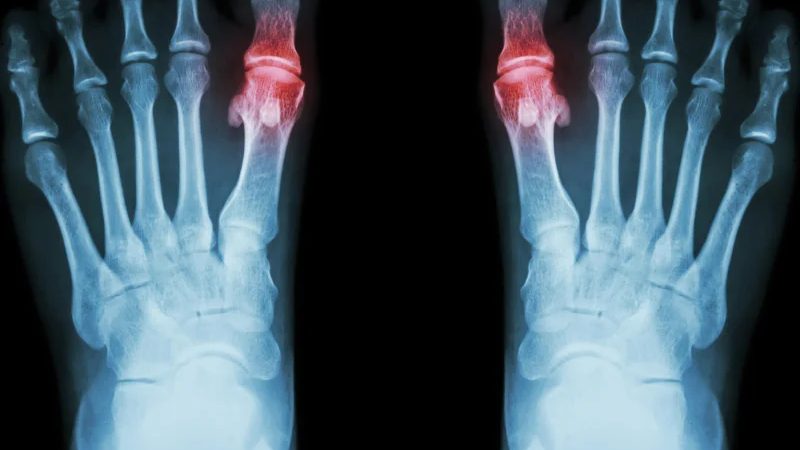 Plasmapheresis for Rheumatoid Arthritis: When Is It Used?