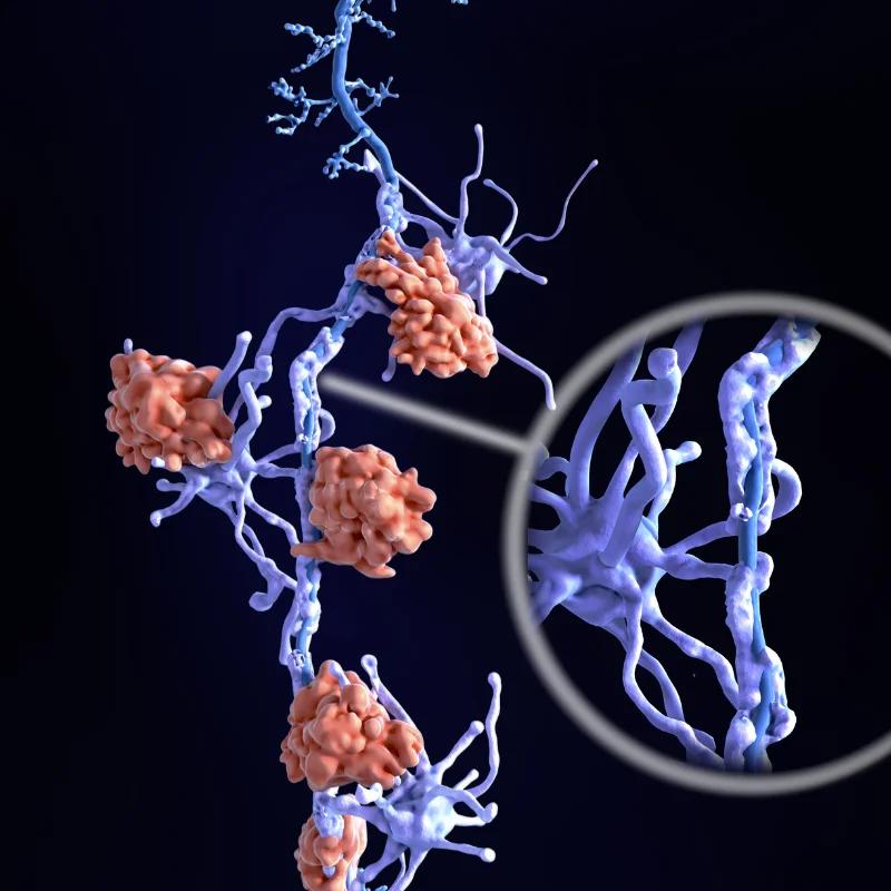 How Plasmapheresis Treats Multiple Sclerosis: Risks and Effectiveness