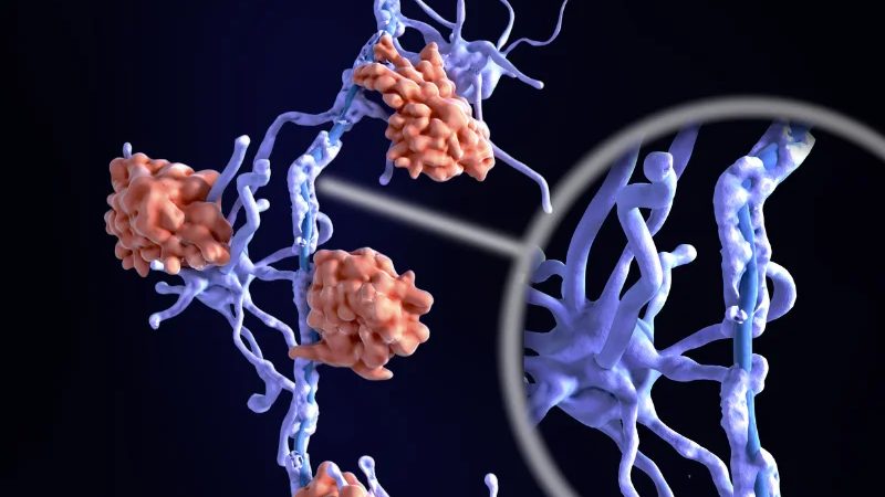 How Plasmapheresis Treats Multiple Sclerosis: Risks and Effectiveness