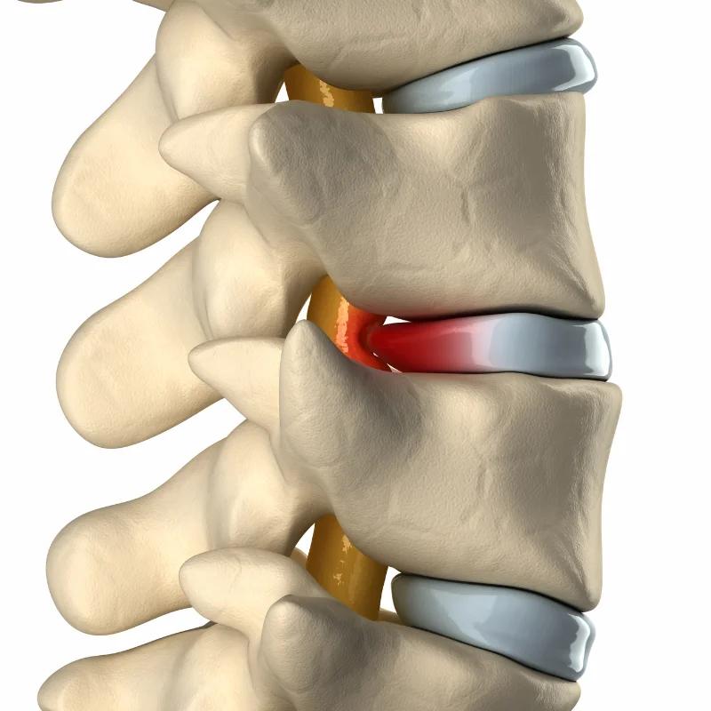 stem cell for disc pain