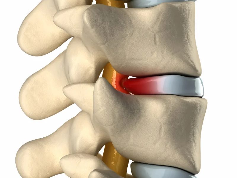 stem cell for disc pain