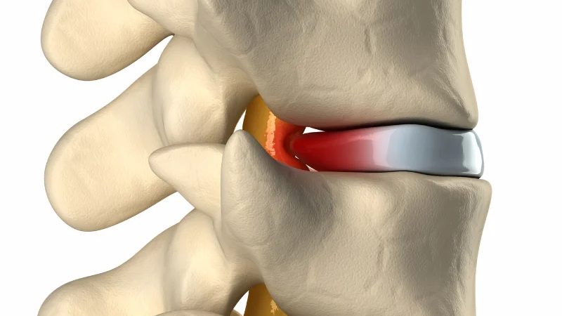 stem cell for disc pain